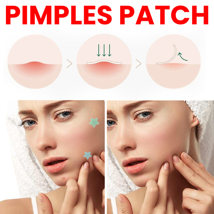 Star Hydrocolloid Pimple Patches, 200-Count Acne Set
