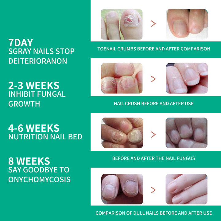 Nail Fungus Care Essence for Clearer, Stronger Nails