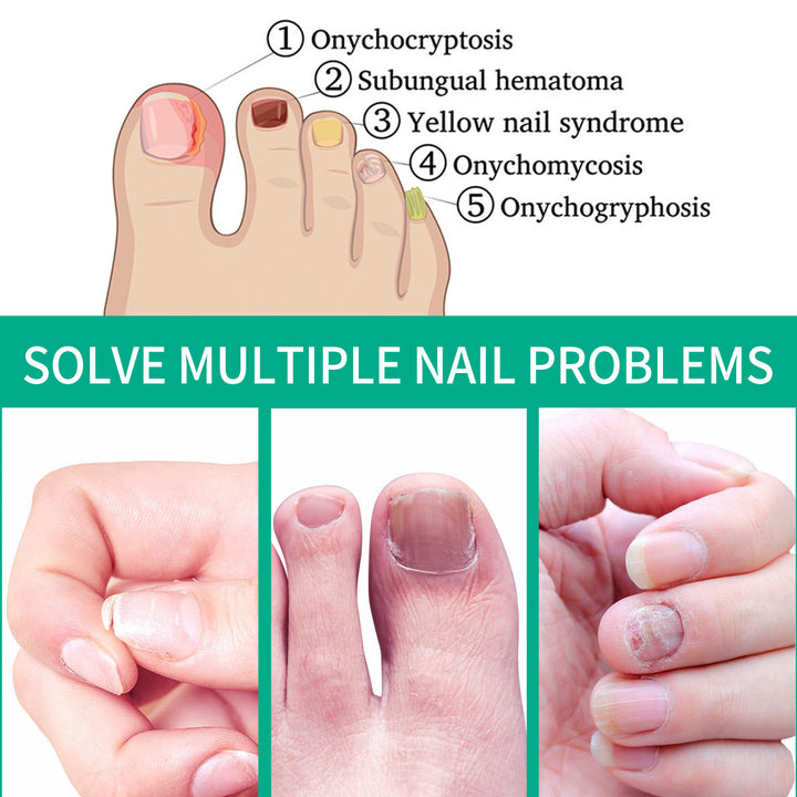 Nail Fungus Care Essence for Clearer, Stronger Nails
