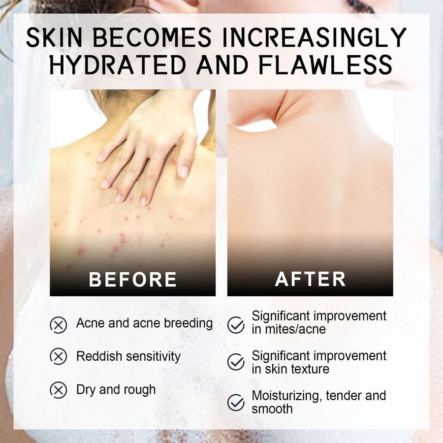 Back Acne Silk Soap for Hydrated, Smoother Body Skin