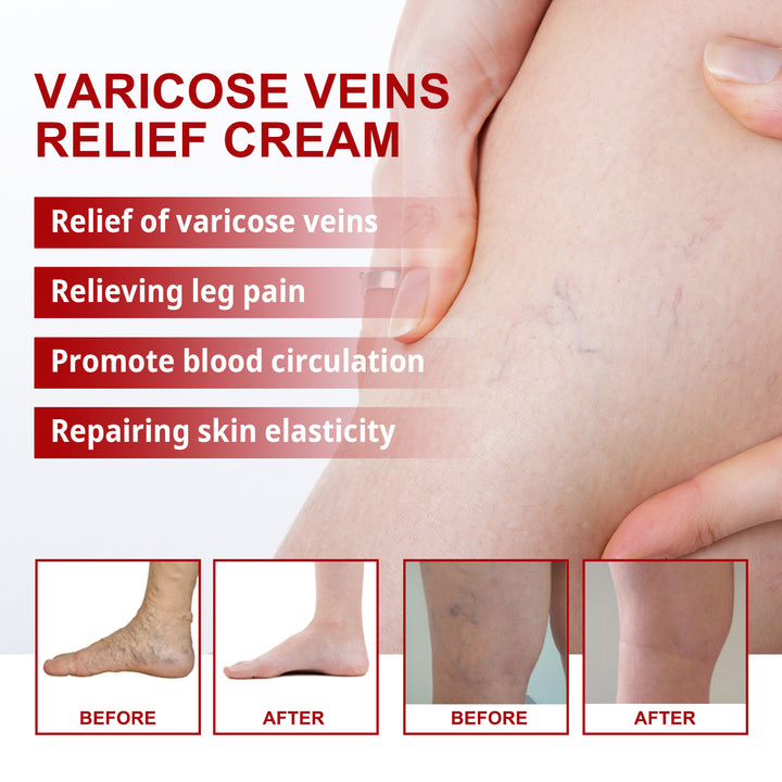 Varicose Vein Cream for Tired Legs, Massage Relief
