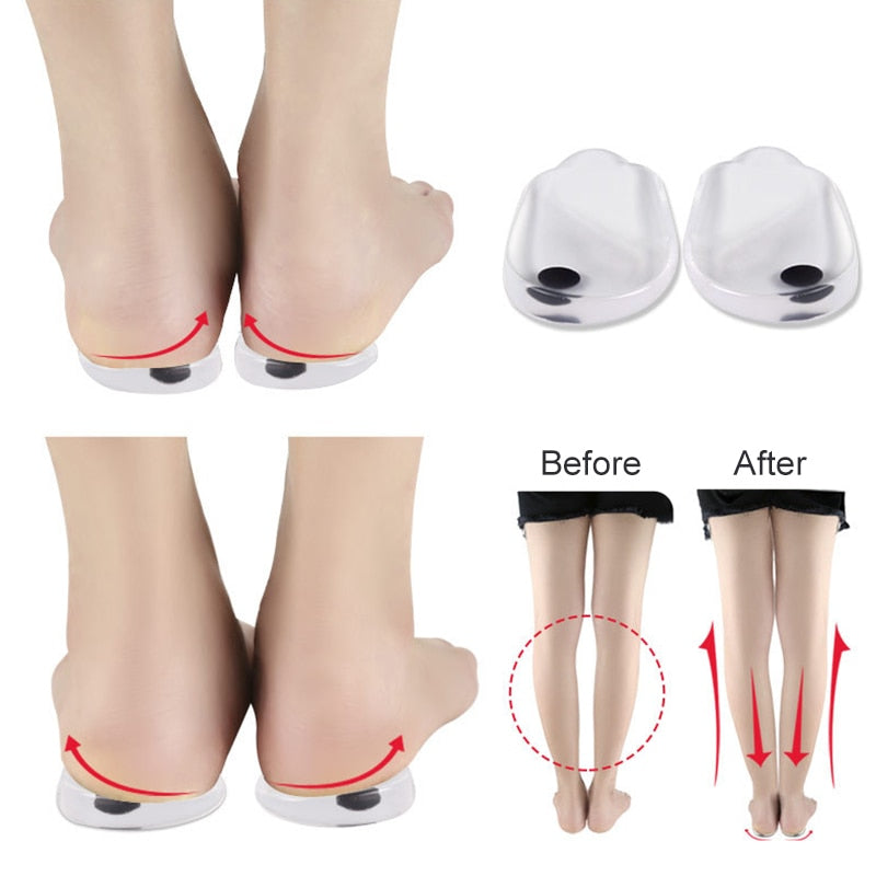 O/X Leg Corrector Insoles — Visible Leg Straightening