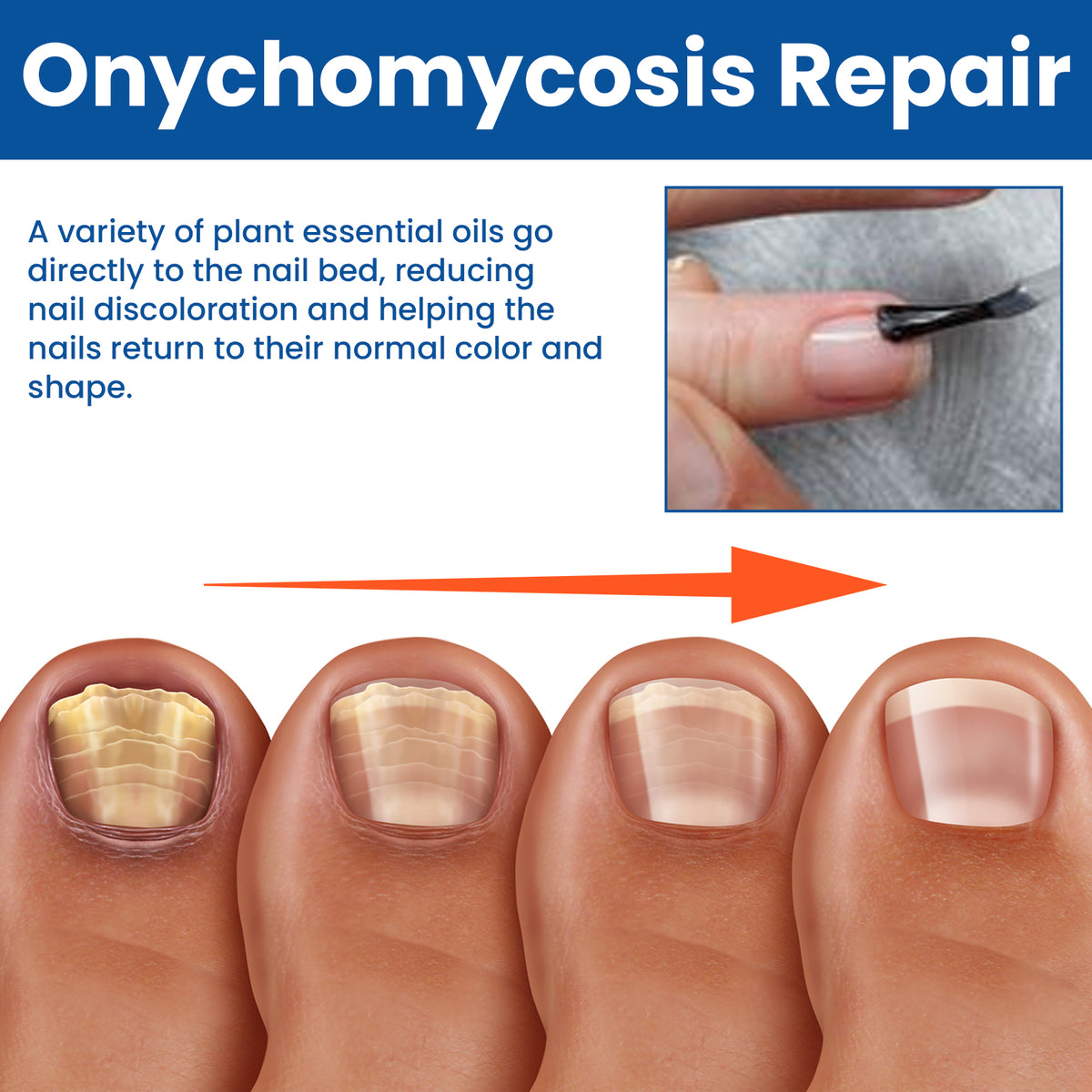 Nail Repair Treatment for Thick, Discolored Nails