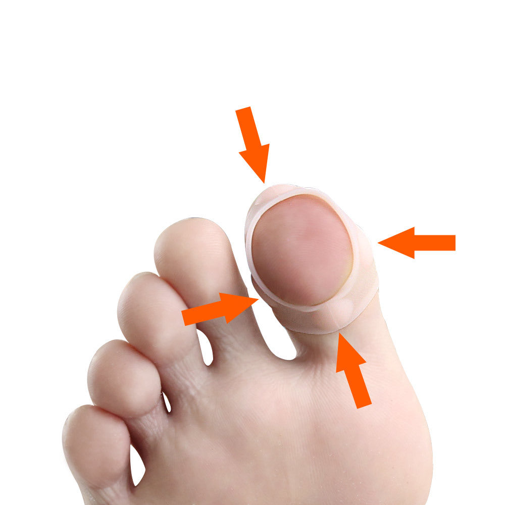 Silicone Ingrown Toenail Corrector — Painless