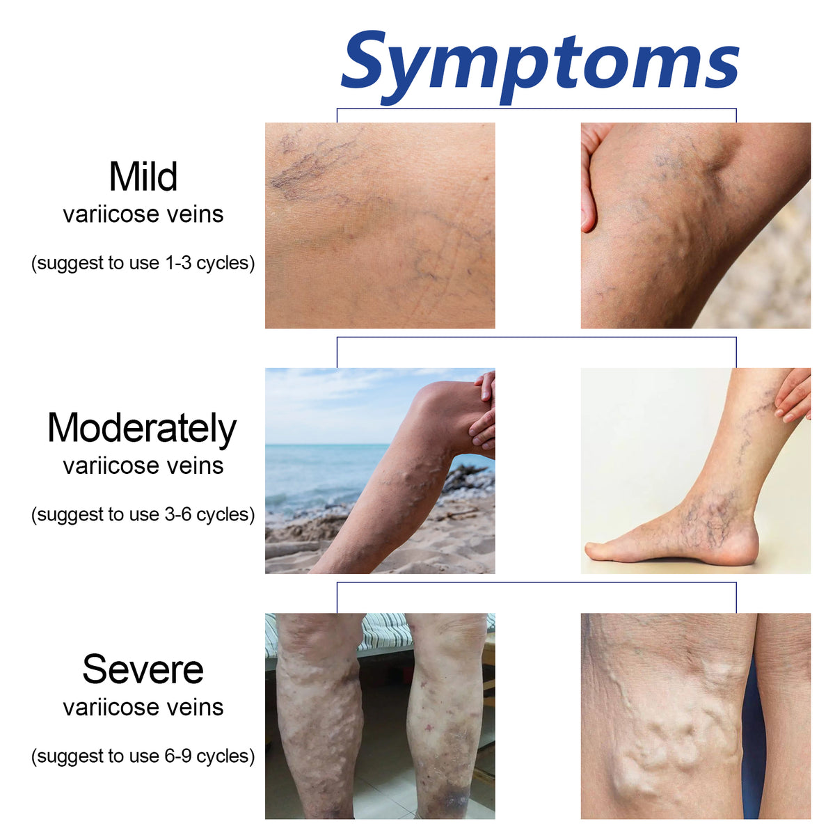 Compression Leg Sleeves for Calf Swelling Relief at Home