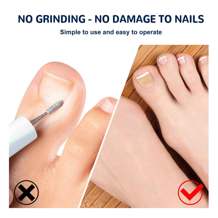 Toenail Correction Patches — Painless Ingrown Nail Relief