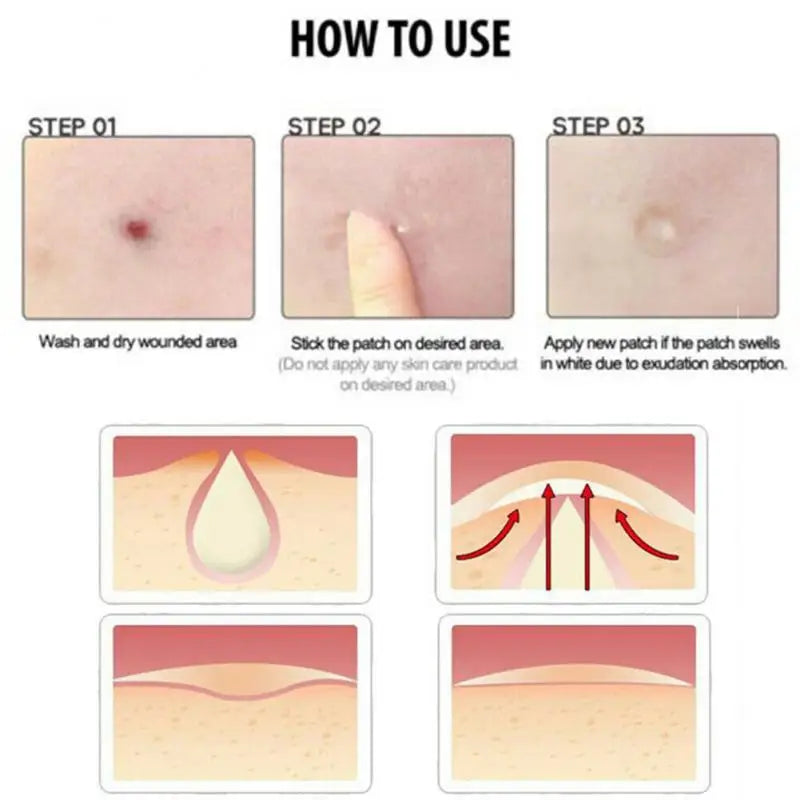 Pimple Patches, Invisible Acne Spot Covers, 36-Piece