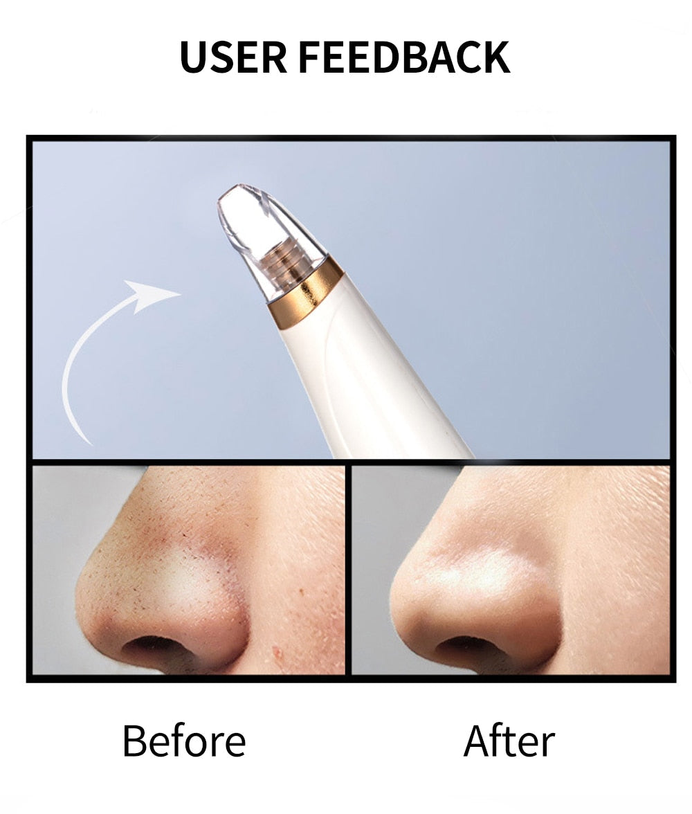Blackhead Vacuum Pore Cleaner with 3 Suction Heads