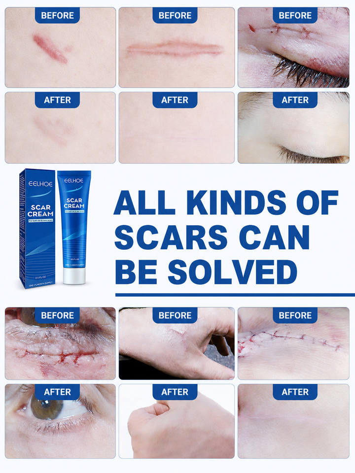 EELHOE Scar Cream — All Scar Types, 30-Day Cycle