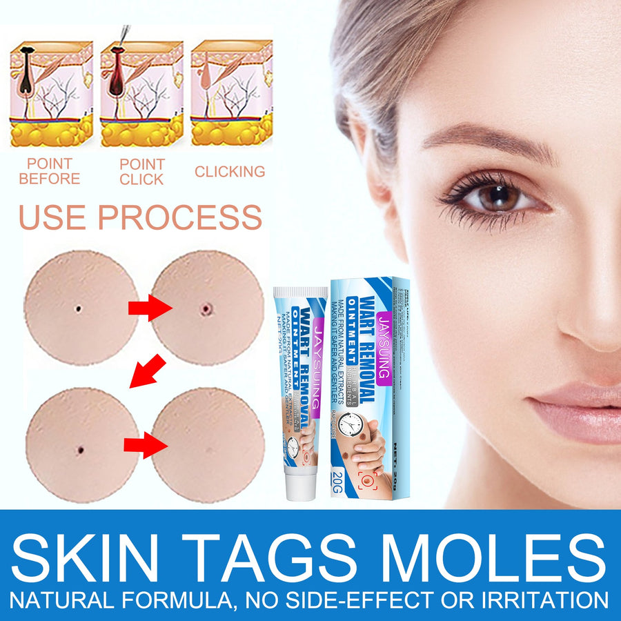 Topical Wart Removal Cream for Gentle At-Home Care