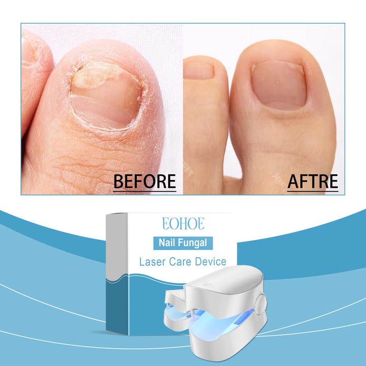 Laser Nail Care Device for Healthier-Looking Nails