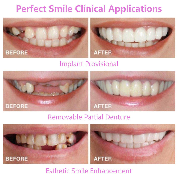 Teeth Simulation Veneers — Instant Bright Smile, No Dentist