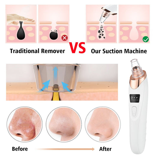 Blackhead Remover Vacuum for Clearer-Looking Pores