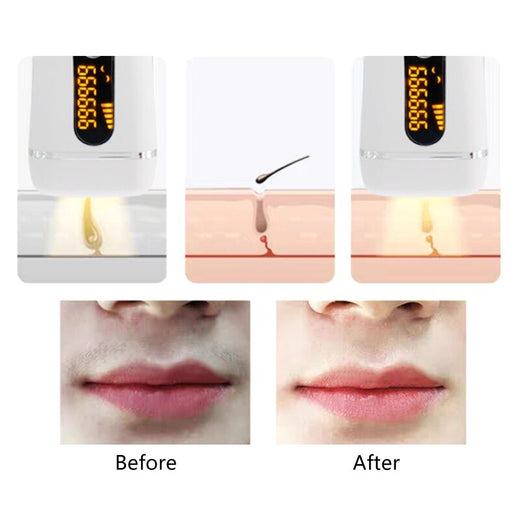 IPL Hair Removal Device for Smoother Skin at Home