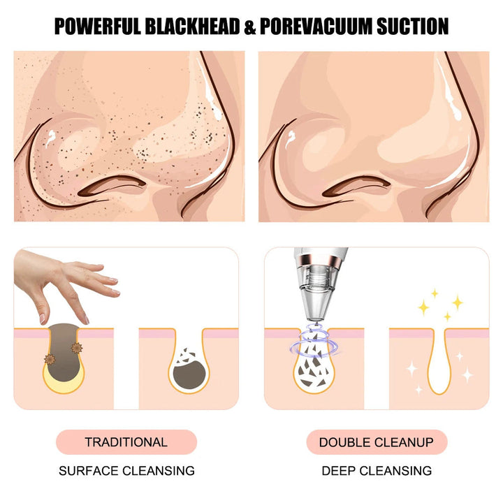 Blackhead Remover Vacuum — Professional Pore Cleansing at Home