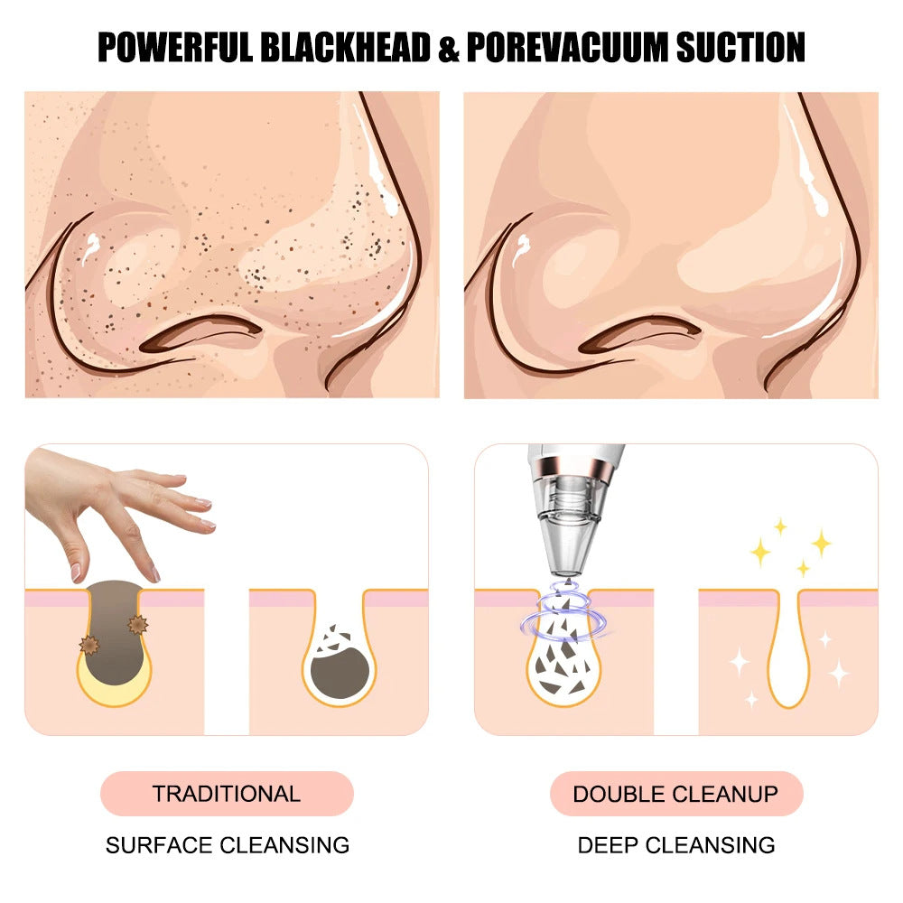 Blackhead Remover Vacuum — Professional Pore Cleansing at Home