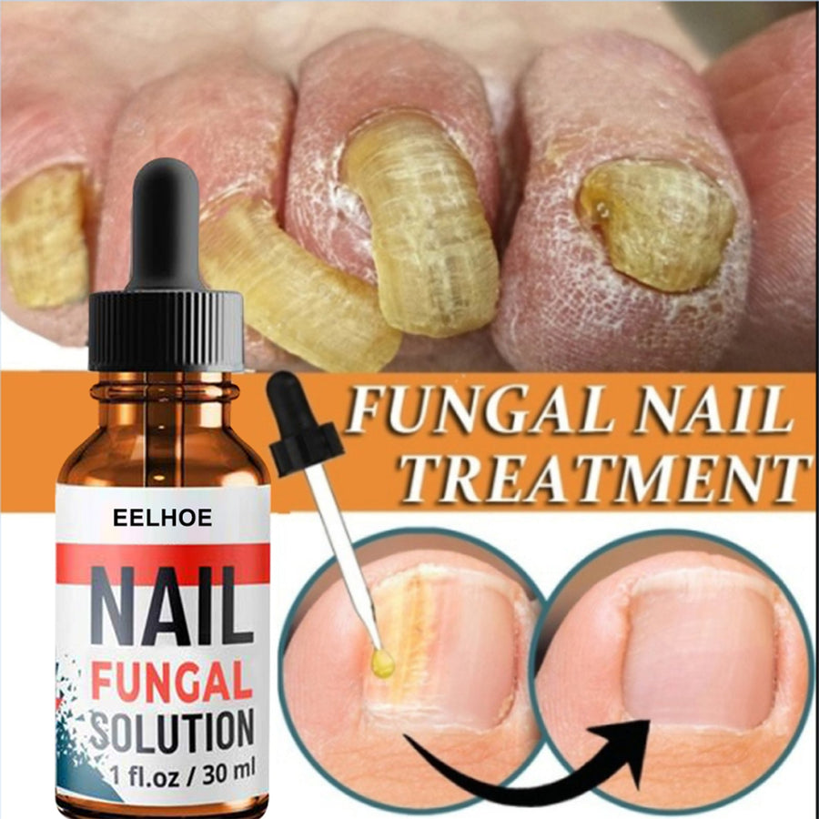 Nail Fungus Treatment — Clearer, Healthier Nails in 4-8 Weeks