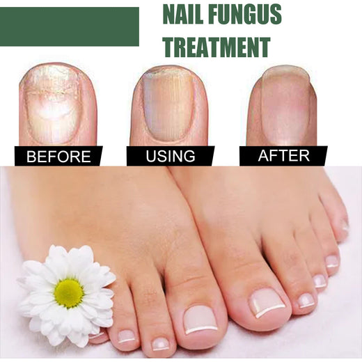 EELHOE Natural Antifungal Nail Treatment Liquid 50ml