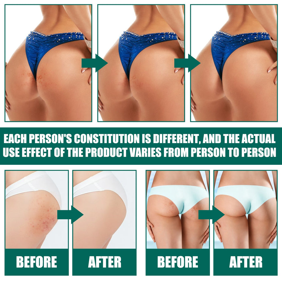 Butt Acne Cream for Smoother, Hydrated Body Skin Care