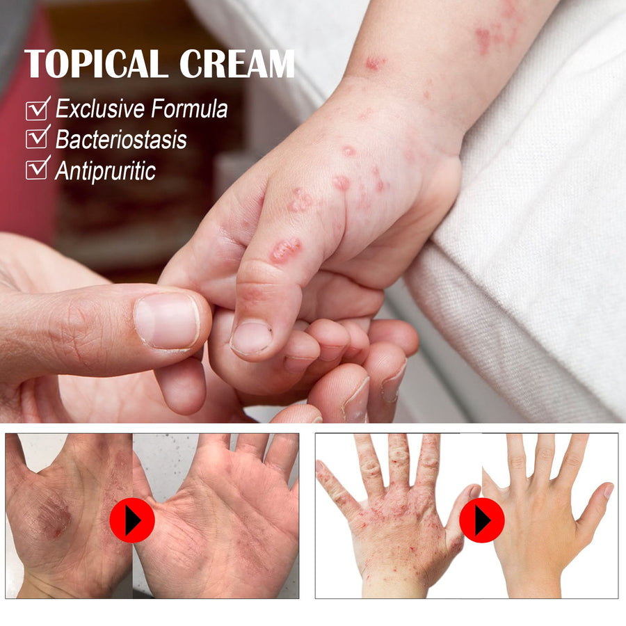 Anti-Itch Cream — Fast Herbal Relief for Bug Bites & Rashes