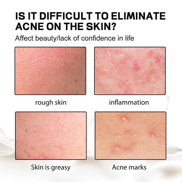Back Acne Silk Soap for Hydrated, Smoother Body Skin