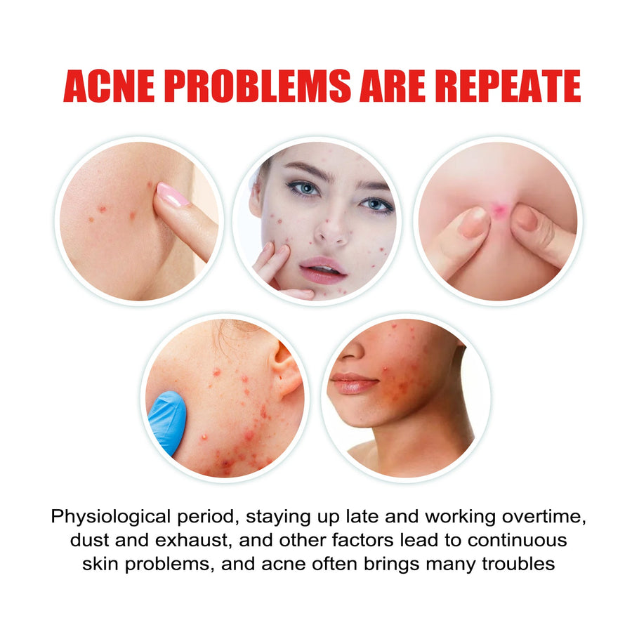 Cloud Acne Patches for Gentle, Non-Drying Blemish Care