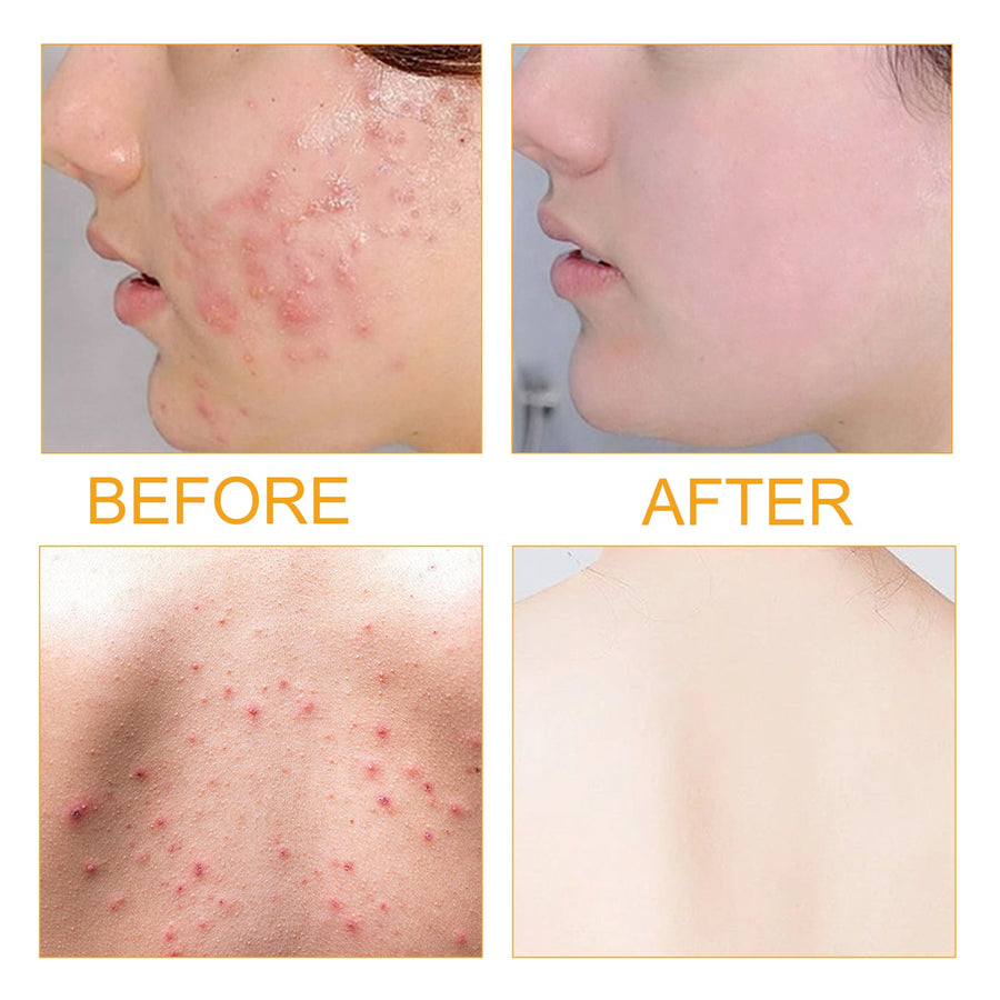 Vitamin C Acne Serum for Clearer, Nourished-Looking Skin