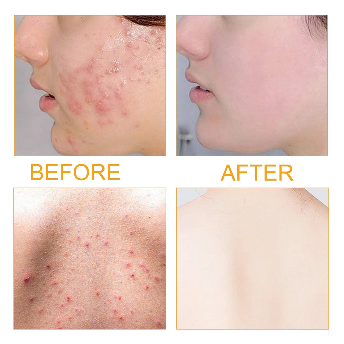 Vitamin C Acne Serum for Clearer, Nourished-Looking Skin