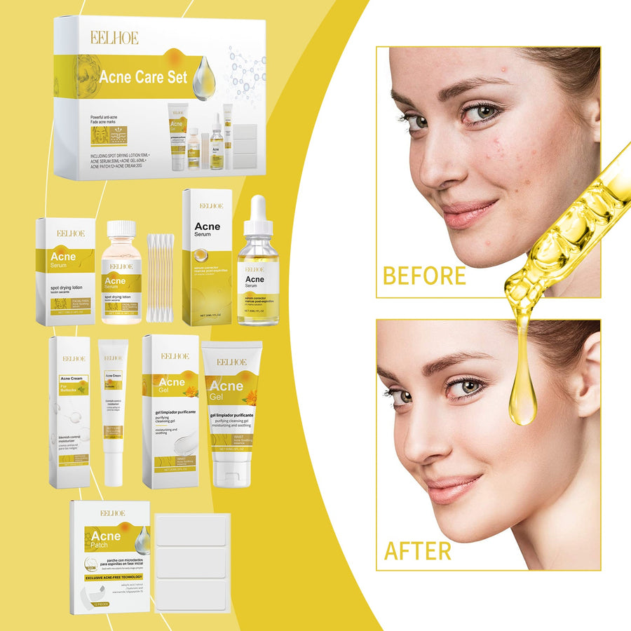 Acne Skincare Set for Oil-Control and Daily Hydration