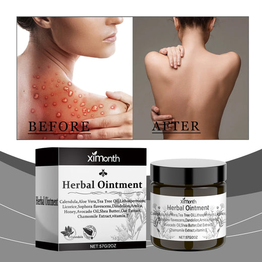Herbal Eczema Cream – Soothes Dry, Itchy Skin on Hands & Feet