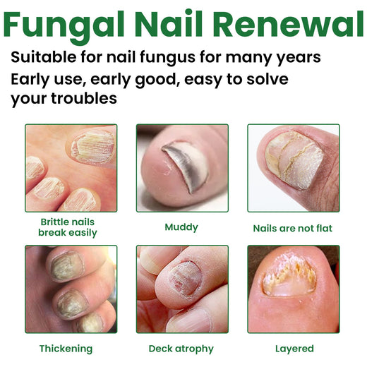 Fungal Nail Treatment — Clear, Healthy Nails in 36 Hours