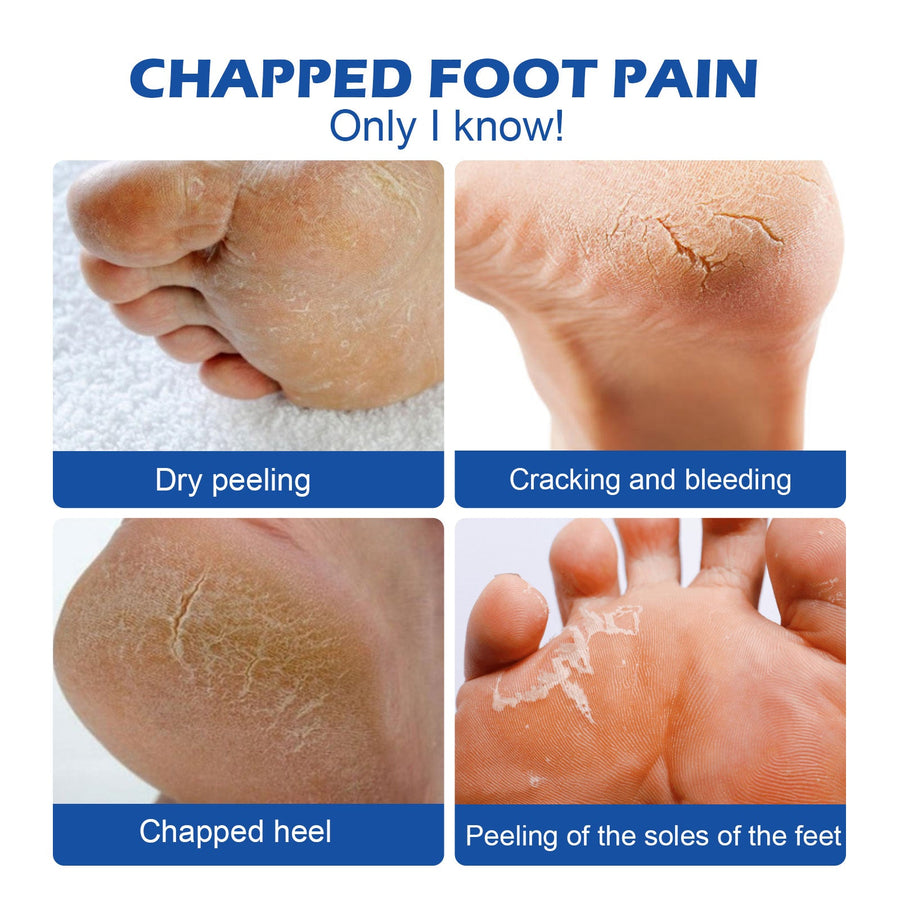 45% Urea Foot Cream for Cracked, Rough, Dry Skin Care