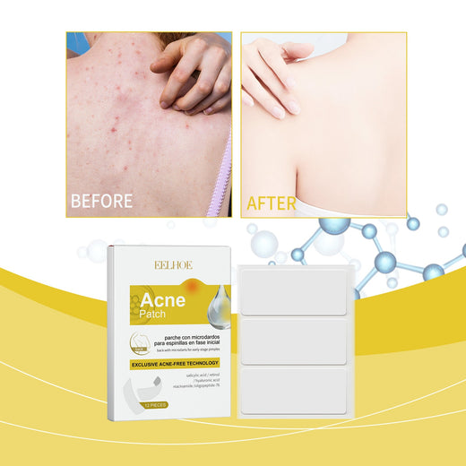 Back Acne Patches with Microdarts for Fast Clearing