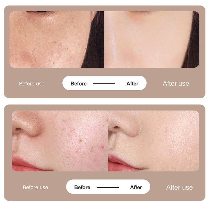 LCD Beauty Mole Scanning Pen — Professional Acne Treatment