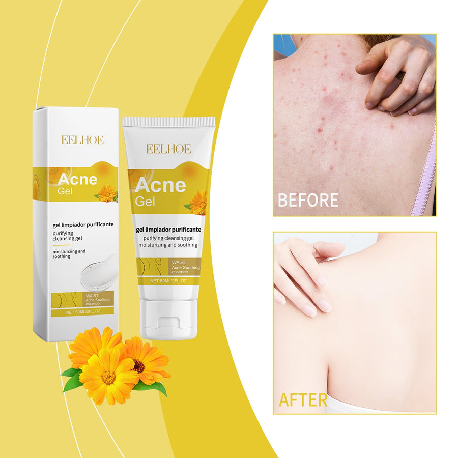 Body Acne Gel — Clear Breakouts with Calendula & Aloe