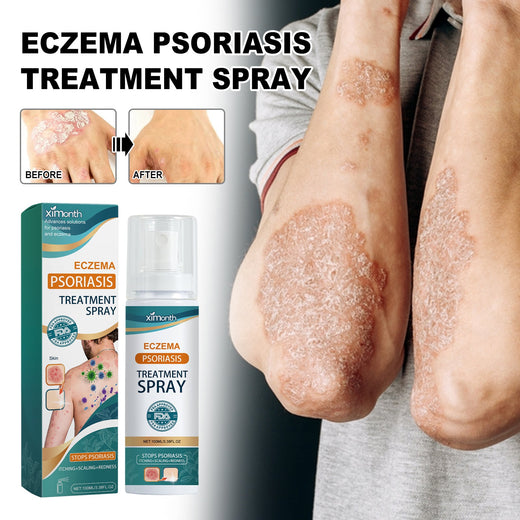 Eczema Psoriasis Spray - Stops Itching, Scaling & Redness
