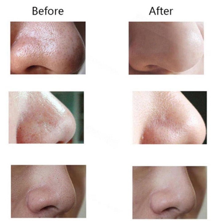 Pore Vacuum Blackhead Remover — Clearer Skin in 2 Weeks