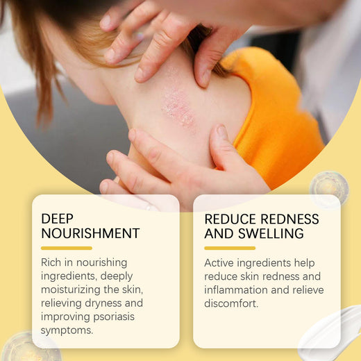 Herbal Psoriasis Cream - Steroid-Free Skin Relief