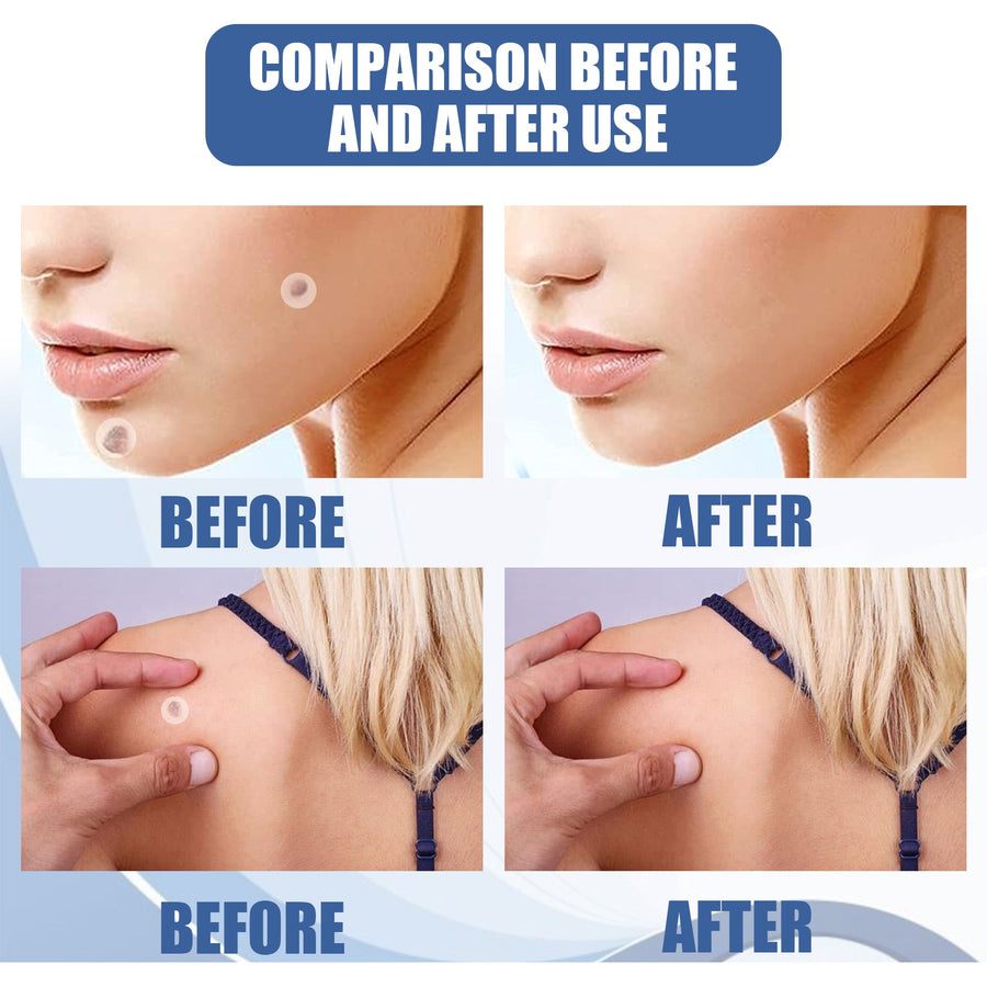 Skin Tag Patches – 144 Gentle Mole & Wart Removal Patches