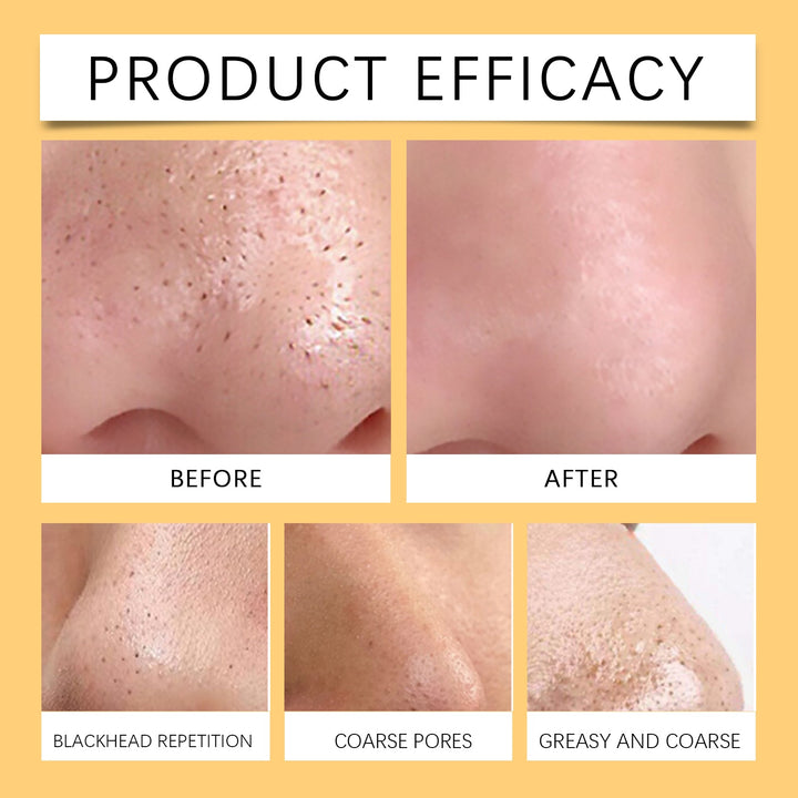 Hydrocolloid Nose Patches for Cleaner-Looking Pores