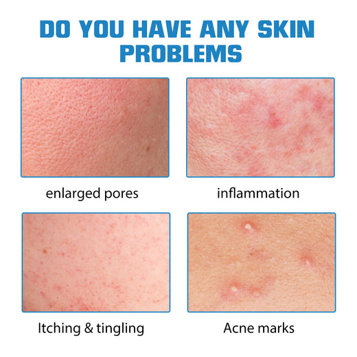 Hyaluronic Acid Serum for Acne Marks & Dry Skin