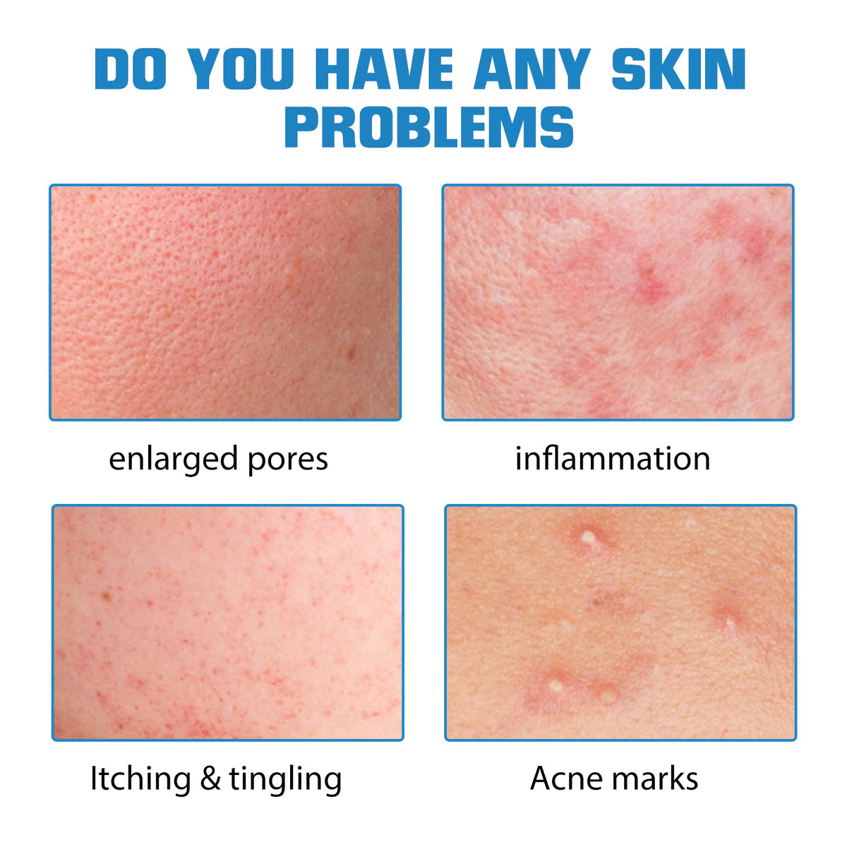 Hyaluronic Acid Serum for Acne Marks & Dry Skin