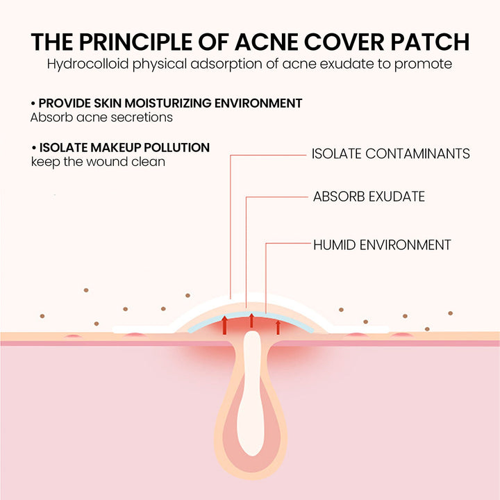 Hydrocolloid Acne Patches for Gentle Blemish Coverage