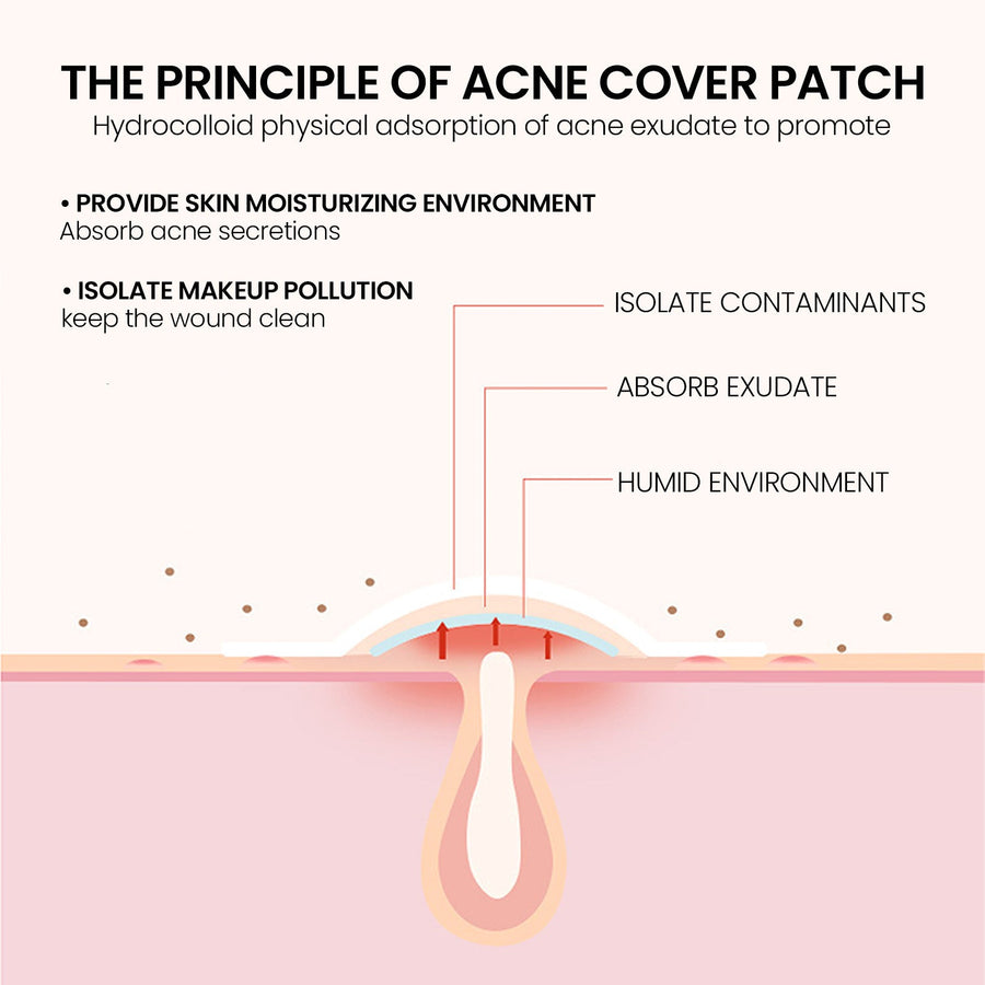 Hydrocolloid Acne Patches for Gentle Blemish Coverage