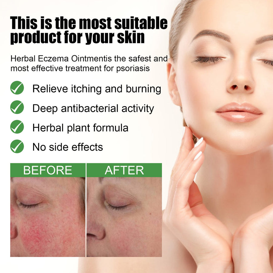 Eczema Ointment — Fast Itch Relief with Herbal Calendula Formula