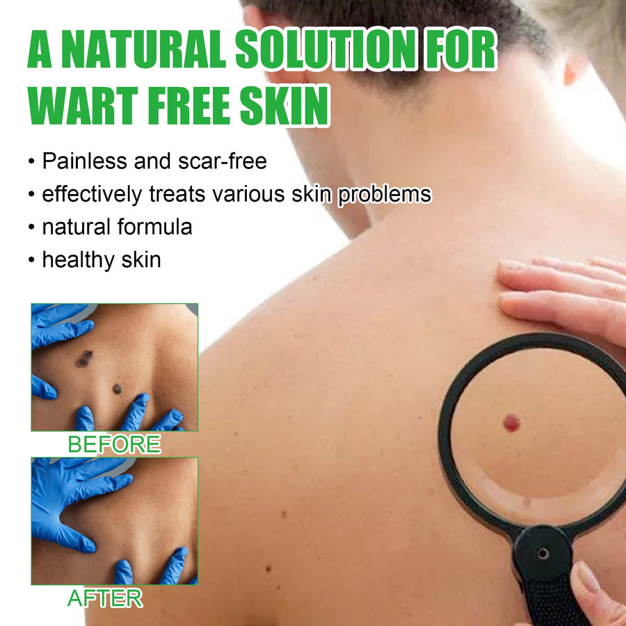 Mole Remover Soap — Painless, Scar-Free Wart & Blemish Removal