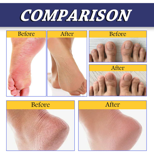 Tea Tree Oil Foot Balm — Heal Cracked Heels & Dry Skin
