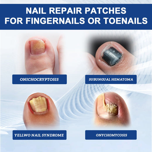 Fungal Nail Patches, Repair Thickening Gray Nail Rotten Nail