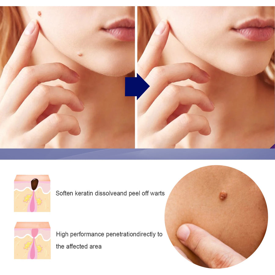Wart Remover Ointment — Painless Natural Removal at Home