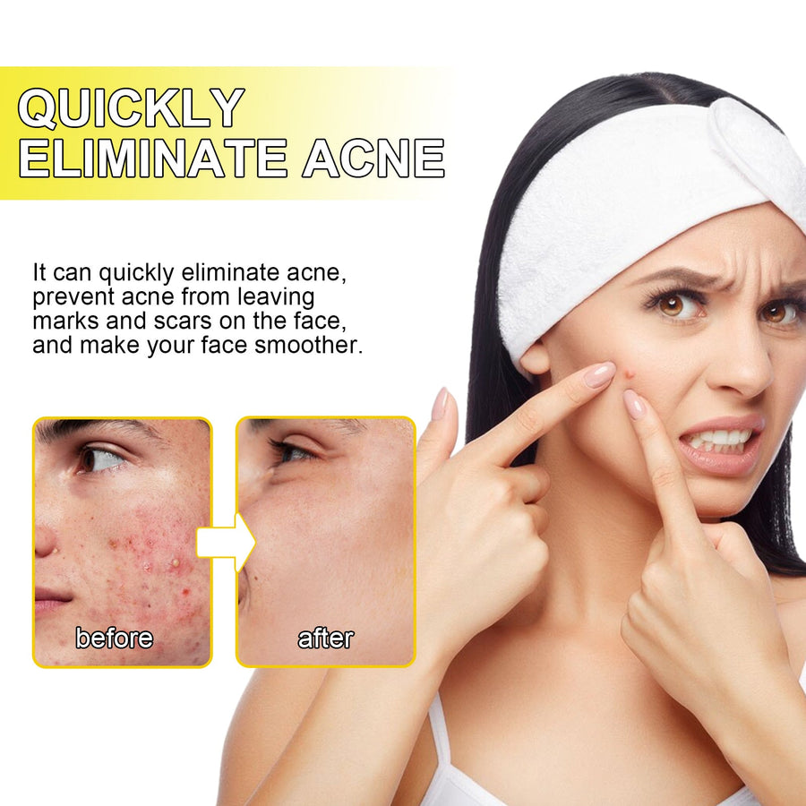 Hydrocolloid Acne Patches for Discreet Blemish Cover
